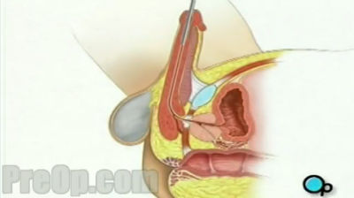 MEDICINA ONLINE VIDEO Cistoscopia  maschile – Male cystoscopy