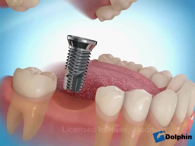 Implante dentário posterior