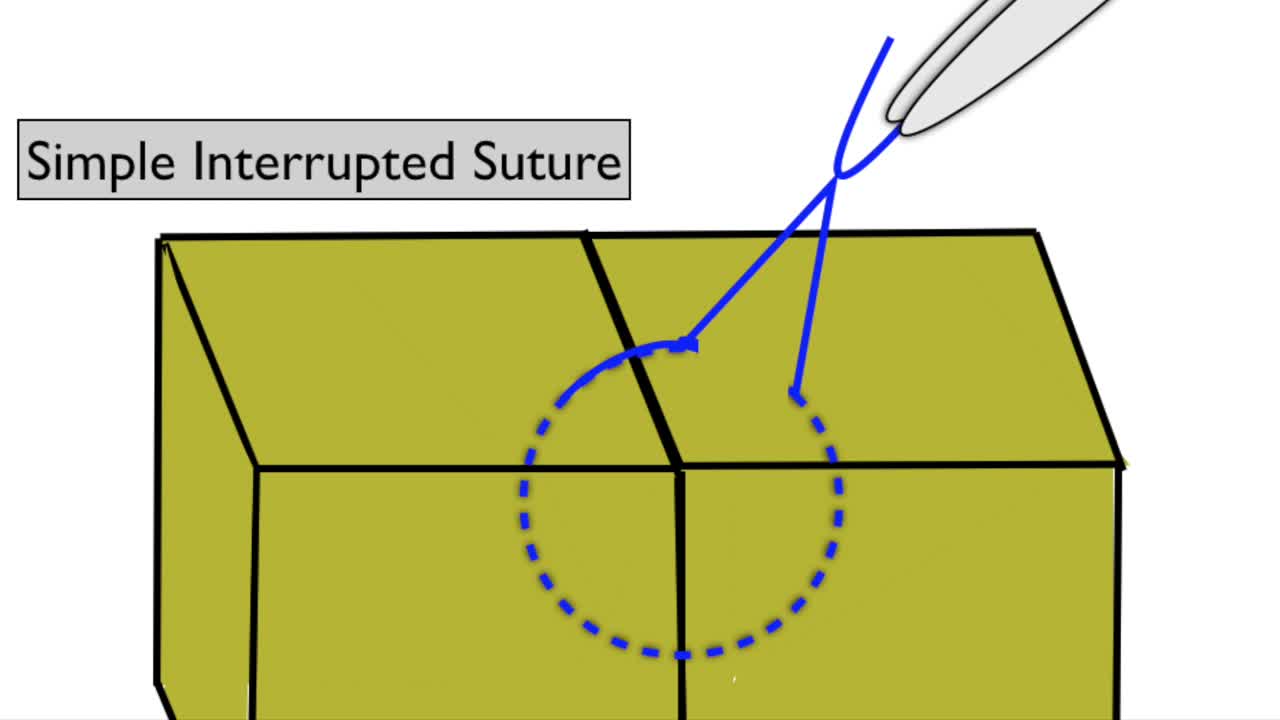 Suture Removal – Closing the Gap