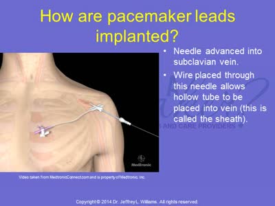 What is a Pacemaker Lecture 3