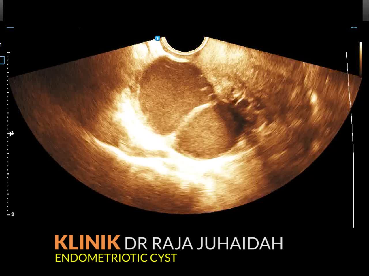Video: Endometriotic Cyst - Dr R Juhaidah Blog
